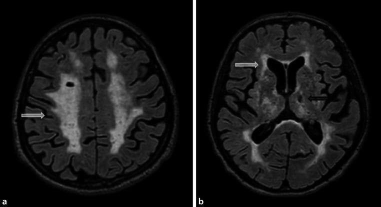 Two axial Magnetic Resonance Imaging (MRI) brain scans using Fluid-Attenuated Inversion Recovery (FLAIR) sequences, illustrating hallmarks of small vessel disease and vascular dementia in an elderly patient. Image (a) demonstrates extensive, confluent periventricular white matter hyperintensities (WMH), indicated by a white arrow, reflecting Fazekas grade 3 changes. These bright, diffuse signals surround the lateral ventricles and extend deep into the subcortical white matter. Image (b) shows a similar pattern of confluent WMH alongside a focal structural abnormality: a lacune in the left thalamus (black arrow). The lacune appears as a small, well-defined, ovoid area of low signal intensity, matching the suppressed signal of cerebrospinal fluid (CSF), indicating a chronic lacunar infarct. Collectively, these findings represent severe leukoaraiosis and multi-infarct pathology, characteristic of chronic cerebral microvascular compromise.