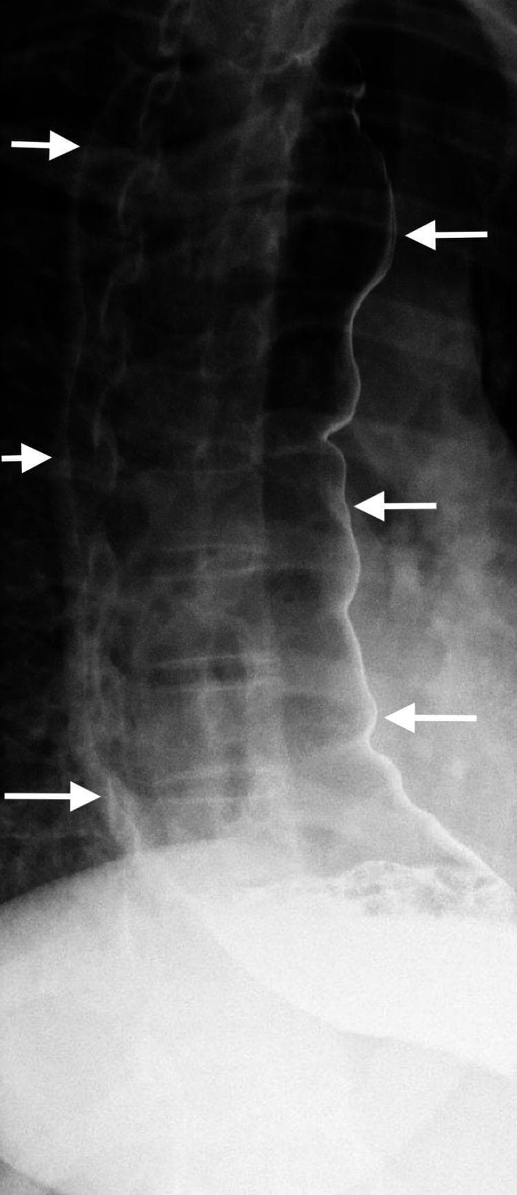 This diagnostic image is a barium swallow esophagram (X-ray radiography) illustrating end-stage achalasia. The primary finding is a massively dilated, tortuous, and elongated thoracic esophagus, referred to as a 'sigmoid esophagus' or 'S-shaped' esophagus due to its resemblance to the sigmoid colon. White arrows delineate the lateral and medial borders of the dilated lumen, which is filled with radiopaque contrast. The esophageal body shows significant loss of primary peristalsis and characteristic pooling of barium. Distally, the esophagus exhibits smooth tapering near the gastroesophageal junction (GEJ), which typically presents as the 'bird-beak' sign in this pathology, though the distal-most segment is partially obscured by the extensive pooling in the dilated lumen. This visual is characteristic of chronic, severe achalasia leading to decompensation of the esophageal musculature. It is a critical educational resource for understanding advanced gastrointestinal motility disorders and the radiological manifestations of obstructive esophageal pathology in a clinical setting.