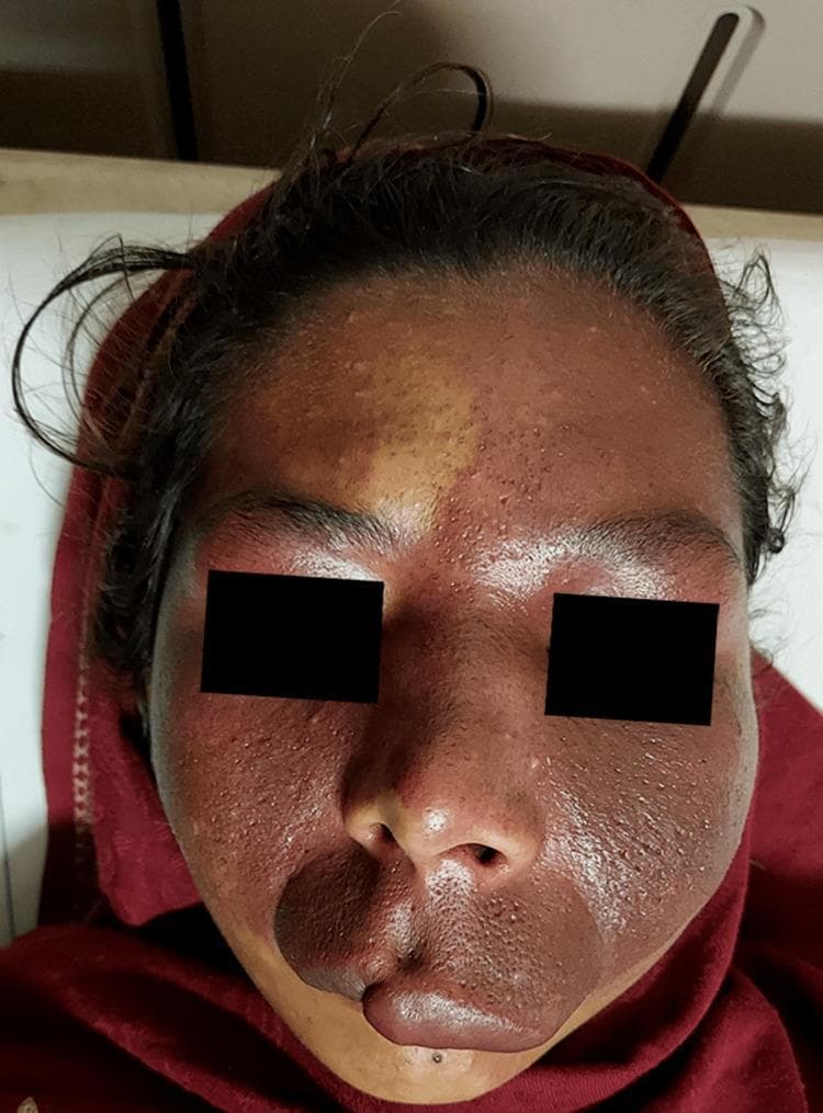 Clinical photograph of a patient's face displaying a large port-wine stain (PWS), a congenital capillary malformation. The lesion exhibits characteristic deep red to purple discoloration with a predominant distribution on the left side of the face. Anatomically, the stain involves the dermatomes associated with the ophthalmic (V1) and maxillary (V2) divisions of the trigeminal nerve on the left, while also crossing the midline to involve the maxillary division on the right side. The affected areas include the forehead, periorbital regions, bilateral cheeks, nose, upper lip, and chin. Visually, the PWS demonstrates varying color intensity and textural irregularities, including subtle surface nodularity and enlarged pores, which are typical of aging vascular lesions. Notably, there is a distinct midline demarcation on the forehead. This clinical presentation is highly suggestive of Sturge-Weber syndrome, especially when associated with neurological or ocular findings. This image is an educational example of segmental vascular malformations and their dermatomal correlations.