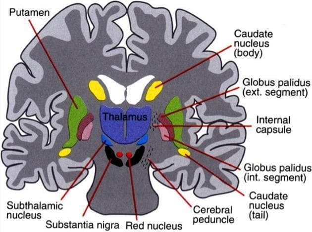 This medical illustration presents a labeled coronal section of the human brain, focusing on the anatomical organization and spatial relationships of the basal ganglia and associated subcortical structures. The diagram depicts the striatum, comprising the caudate nucleus (body and tail) and the putamen, which is situated laterally to the globus pallidus (external and internal segments). The internal capsule is shown as a white matter tract separating the caudate body from the lentiform nucleus. Centrally, the thalamus is positioned superior to the midbrain structures. Deep to the thalamus, the subthalamic nucleus is identified, sitting immediately superior to the substantia nigra. The red nucleus and cerebral peduncles are also visualized within the midbrain region. The use of distinct color-coding—green for the putamen, yellow for the caudate, and blue for the thalamic regions—enhances the educational value for understanding the functional anatomy of motor control circuits and the cortico-striato-thalamo-cortical loops relevant to neurology and neurosurgery.