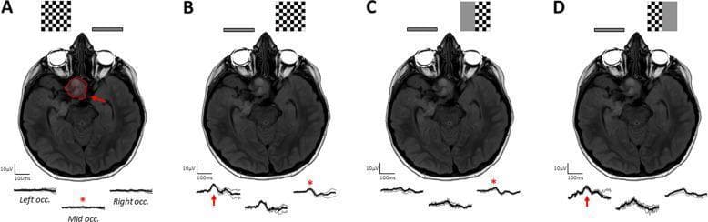 This composite educational graphic illustrates the neuro-ophthalmological findings of an optic pathway glioma in an 8-year-old patient. The image features four panels (A-D), each combining an axial brain MRI, stimulus diagrams, and Pattern Reversal Visual Evoked Potential (PR-VEP) waveforms. The MRI consistently shows a large infiltrative lesion (outlined in red in panel A) involving the left optic nerve, optic chiasm, and left optic tract. Panel A demonstrates total PR-VEP extinction during left eye stimulation, reflecting severe macular pathway dysfunction. Panels B, C, and D evaluate the right eye using full-field, right half-field, and left half-field checkerboard stimuli, respectively. The resulting transoccipital waveforms (recorded at left, middle, and right occipital locations) show asymmetric responses: panel B exhibits attenuated signals over the right occiput, and panel C shows reduced ipsilateral positivity. Panel D reveals preserved positivity, indicating that while crossing fibers are compromised, non-crossing fibers from the right eye remain functional. This case demonstrates the clinical utility of VEP distribution analysis in localizing chiasmal and retrochiasmal compressive lesions.