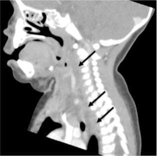 This diagnostic image is a sagittal view of a computerized tomography (CT) scan of the neck and upper thorax. The image demonstrates a large retropharyngeal abscess, characterized by a well-defined hypodense (darker) fluid collection. Black arrows indicate the longitudinal extent of the collection as it occupies the retropharyngeal space, located anterior to the cervical vertebrae and posterior to the pharynx and esophagus. Notably, the abscess tracks caudally from the cervical region, crossing the thoracic inlet and extending into the posterior mediastinum. The surrounding soft tissues show significant edema and displacement. Anatomical landmarks visible include the oral cavity, nasal passages, cervical spine, and superior mediastinal structures. This clinical finding is of high significance due to the risk of descending necrotizing mediastinitis. The image is intended for medical education regarding deep neck space infections and their potential routes of anatomical spread.