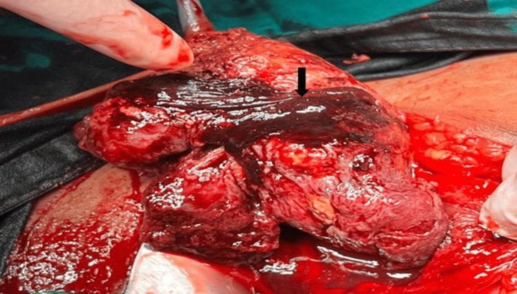 This clinical photograph captures an intraoperative view during an obstetric surgical procedure, illustrating a concealed placental abruption. The primary focus is the exposed uterus, which appears highly vascularized and congested with significant hemoperitoneum. A prominent, dark-red to black retroplacental hematoma is indicated by a black arrow, representing a large blood clot typical of placental abruption. The blood varies in color from bright red (fresh hemorrhage) to deep purple/black (older, organized clot), covering a substantial portion of the uterine tissue. The surgical context is reinforced by the presence of a gloved hand and a metal retractor holding the surgical margins. This image serves as an educational example of placental pathology and obstetric complications, specifically demonstrating the gross appearance of retroplacental bleeding and localized tissue necrosis following placental separation from the uterine wall.