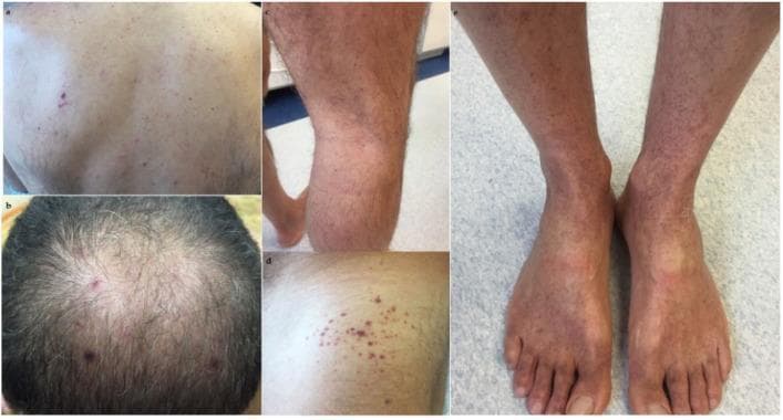 A series of clinical photographs documenting the dermatological manifestations of immune thrombocytopenic purpura (ITP). The images show widespread petechiae—small (1-3 mm), non-blanching, reddish-purple macules caused by capillary hemorrhage—distributed across several anatomical regions. On the back and scalp, the petechiae are relatively sparse and discrete. In contrast, the lower extremities, including the shins and the dorsal surfaces of the feet, demonstrate a higher density of lesions, appearing more confluent and clustered. The morphology is consistent with thrombocytopenia-induced microhemorrhages under the skin. The color variation from bright red to deep purple suggests varying stages of extravasated blood. This visual evidence serves as a clinical marker for evaluating systemic coagulation disorders and platelet dysfunction in a medical education context.