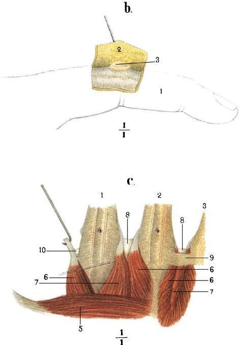 This historical anatomical illustration, likely from a 19th-century monograph, consists of two labeled diagrams (b and c) detailing the musculoskeletal and bursal anatomy of the hand. Diagram 'b' displays a lateral view of an index finger (1), with a flap of subcutaneous tissue (2) reflected upward by a surgical pin to reveal a subcutaneous mucous bursa (3) on the dorsal aspect. Diagram 'c' provides a deep dissection of the hand's dorsal metacarpal region. It illustrates the metacarpal bones II-IV (1-3) along with the associated dorsal interossei muscles (4, 6, 7) and the adductor pollicis (5). Key anatomical focuses include the intermetacarpophalangeal bursae (8) situated between the metacarpal heads, and specific tendinous or ligamentous attachments (9, 10) demonstrated via retraction. These illustrations serve as educational materials for understanding the spatial relationships between bones, intrinsic hand muscles, and the synovial bursae that facilitate movement in the digits and metacarpophalangeal joints.