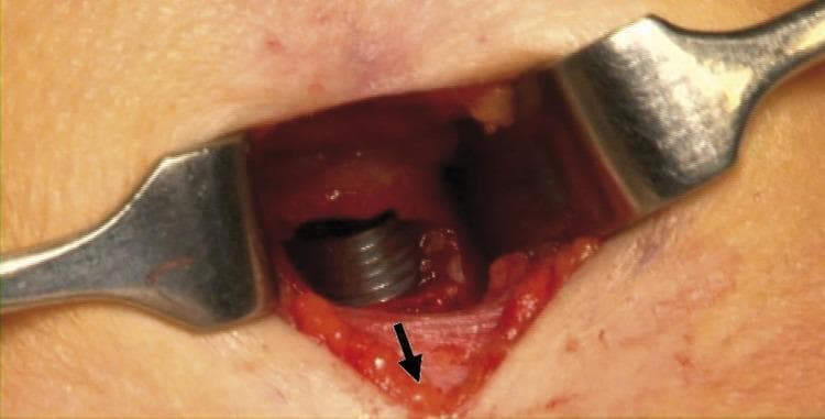 This clinical photograph captures a close-up view of an operative field during a tracheostomy procedure. Metal retractors are positioned to maintain the surgical window through the anterior neck skin and underlying soft tissue. Deep within the incision, a dark-colored, wire-reinforced endotracheal tube (ETT) is visible, showing characteristic spiral threading. The ETT has been advanced caudally (distally) into the airway to protect the pilot cuff from accidental puncture or damage during the creation of the tracheal window. A black arrow points to the exposed cartilaginous tracheal wall, indicating the planned site for the stoma. The image demonstrates key surgical anatomy and airway management safety maneuvers essential for surgical residents and otorhinolaryngology students learning about elective tracheostomy techniques and complication avoidance.