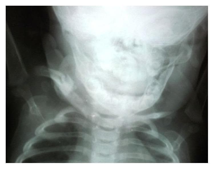 Anterior-posterior (AP) radiograph of a pediatric patient's upper chest and neck region, including the skull, cervical spine, and thorax. The image focuses on the right clavicle, demonstrating the late-stage radiographic appearance of resolved or healing osteomyelitis. The clavicular midshaft shows cortical thickening and mild remodeling, indicative of a resolved infectious process. Surrounding bony structures, including the superior ribs, mandible, and scapulae, are partially visualized. The radiograph illustrates the long-term musculoskeletal outcome and bone regeneration following surgical curettage and antibiotic treatment for a chronic bone infection (osteomyelitis). This diagnostic image is representative of pediatric infectious disease and orthopedic follow-up imaging.