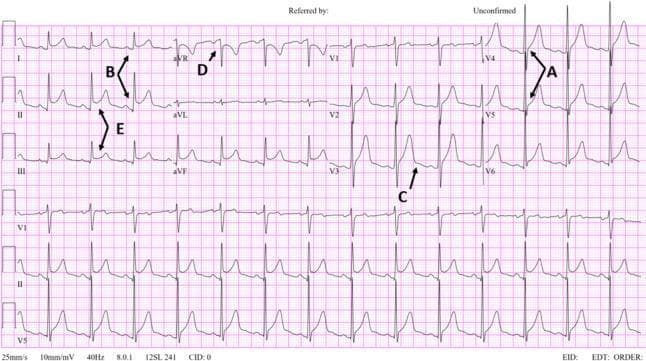 A 12-lead electrocardiogram (ECG) demonstrating pathognomonic findings of acute pericarditis. Key diagnostic features are annotated throughout the tracing: (A) widespread concave ST-segment elevations, most prominent in the lateral precordial leads V4-V6; (B) PR-segment depression, particularly visible in leads I and II; (C) Spodick's sign, indicated by a downsloping T-P segment in lead V3; (D) the 'knuckle sign' in lead aVR, characterized by PR-segment elevation and reciprocal ST-segment depression; and (E) a comparison showing ST-segment elevation in lead II being greater than in lead III, a feature that helps differentiate pericarditis from inferior wall myocardial infarction. The image illustrates Stage 1 of the classical ECG evolution of pericarditis, emphasizing the diffuse nature of the ST-segment changes and the clinical significance of PR-segment shifts and specific morphology signs in diagnosing inflammatory pericardial disease.