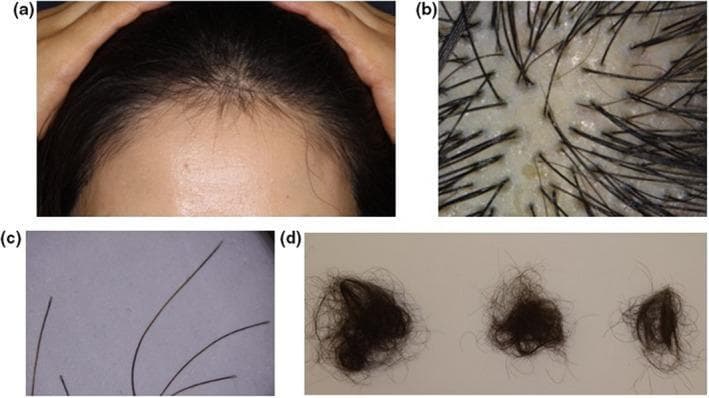 This composite of four images demonstrates clinical and diagnostic findings of Hair Loss After SARS-CoV-2 Infection (HLASCI), characterized as telogen effluvium (TE). (a) Clinical photograph of the frontal scalp of a 57-year-old female showing diffuse thinning and decreased hair density with visible short, regrowing hairs at the hairline. (b) Trichoscopic image (magnified view) of the scalp showing upright regrowing hairs alongside vacant follicular ostia (yellowish dots), which represent empty follicles in the telogen phase. (c) Photomicrograph of shed hairs highlighting terminal hair shafts with tapered tips. (d) Clinical photograph showing clumps of shed hairs with bulbous, club-shaped roots characteristic of telogen hair follicles. Collectively, these images illustrate the typical progression and diagnostic features of post-viral telogen effluvium, including the synchronization of the hair cycle into the shedding phase and subsequent early regrowth. The presentation is relevant for dermatology education regarding secondary hair loss following systemic inflammatory stress or 'cytokine storms' associated with COVID-19.