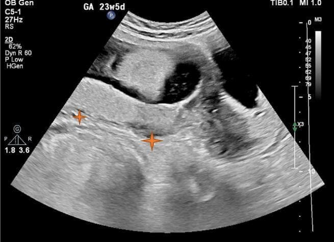 This diagnostic image is an abdominal obstetric ultrasound of a pregnant uterus at 23 weeks and 5 days of gestation. The scan demonstrates the placenta as a homogenous, relatively hyperechoic structure located in the lower uterine segment. Orange star markers indicate the placental tissue extending across and covering the region of the internal cervical os, confirming a diagnosis of placenta previa. Above the placenta, the gestational sac is visible, containing hypoechoic amniotic fluid and fetal parts. The myometrial-placental interface appears clear, with no sonographic evidence of retroplacental hematoma or abnormal placental lacunae. This visual is used to teach placental localization, the sonographic features of placenta previa in the second trimester, and the evaluation of the retroplacental space to rule out abruption. The clinical relevance focuses on managing high-risk pregnancies where placental positioning may lead to antepartum hemorrhage or complicate delivery planning.