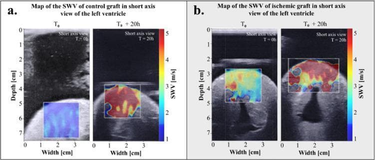 This diagnostic image display consists of two panels (a and b) comparing Shear Wave Velocity (SWV) elastography maps superimposed on B-mode ultrasound images of cardiac grafts. Panel A illustrates a control graft, while Panel B displays an ischemic heart graft, both in short-axis views of the left ventricle at baseline (T0) and after 20 hours (T0 + 20h) of preservation. The SWV color scale on the right of each panel ranges from 1 m/s (blue) to 5 m/s (red), indicating tissue stiffness. At T0, both grafts show predominantly blue and cyan hues, reflecting low initial myocardial stiffness. At T0 + 20h, the control graft shows a shift toward yellow and red, indicating increased stiffness due to cold storage. However, the ischemic graft (Panel B) at T0 + 20h demonstrates a much more pronounced and heterogeneous increase in stiffness, represented by widespread deep red colors across the Region of Interest (ROI). This visual comparison highlights the accelerated stiffening and myocardial damage associated with ischemic injury during organ preservation.