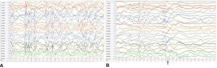 This diagnostic image displays two panels of electroencephalogram (EEG) tracings illustrating classic findings of Infantile Spasms (West syndrome) in a pediatric patient. Panel (A) demonstrates hypsarrhythmia, characterized by a chaotic, high-voltage, and disorganized background. The tracing shows a lack of synchronicity with intermixed irregular slow waves and multifocal independent spikes and sharp waves. Panel (B) illustrates an electrodecremental event, a common ictal feature of infantile spasms. This is visualized as a sudden, brief period of voltage attenuation (flattening of the EEG signal) following a high-amplitude wave. An arrow indicates the onset of the clinical spasm corresponding with this abrupt decrease in amplitude. Both panels utilize a multi-channel bipolar montage, providing a comprehensive view of the cortical electrical dysfunction. These findings are critical diagnostic markers for epileptic encephalopathy and are used to guide urgent treatment with ACTH or high-dose steroids.