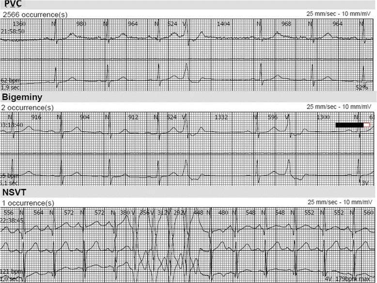 This diagnostic image displays three electrocardiography (ECG) rhythm strips illustrating various forms of ventricular ectopy. The recordings are calibrated at a standard paper speed of 25 mm/sec and a voltage of 10 mm/mV.
1. PVC (Premature Ventricular Contraction): The top strip shows frequent isolated ectopic beats. Each 'V' complex is characterized by a premature, wide, and bizarre QRS morphology lacking a preceding P-wave, followed by a compensatory pause.
2. Bigeminy: The middle strip demonstrates a repetitive pattern where every normal sinus beat ('N') is followed by one premature ventricular contraction ('V'). This 1:1 ratio between normal and ectopic beats is a hallmark of ventricular bigeminy.
3. NSVT (Nonsustained Ventricular Tachycardia): The bottom strip depicts a brief run of four consecutive wide-complex ventricular beats at a rate of 121 bpm, which spontaneously terminates and returns to sinus rhythm.
Each strip includes metadata such as the heart rate, duration of the event, time of recording, and occurrence count, providing clinical context for arrhythmia burden assessment in a cardiology or sleep apnea study setting.