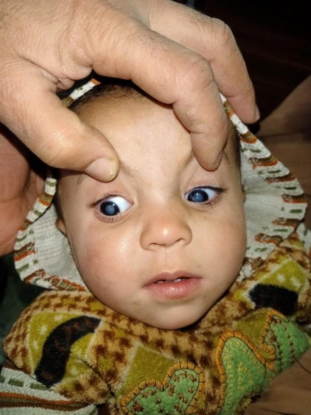 A clinical photograph of an infant demonstrating leukocoria (white pupillary reflex) and anisocoria. An adult's hand is seen retracting the infant's right upper eyelid to facilitate visualization of the globe. The right pupil exhibits a prominent, milky-white opacification, characteristic of an abnormal red reflex. There is visible nasal deviation of the right eye, suggesting esotropia or pseudostrabismus. The left pupil appears comparatively darker with a bluish-gray hue. This visual presentation is critical in pediatric ophthalmology for the differential diagnosis of conditions such as congenital cataracts, retinoblastoma, or Coats' disease. The image illustrates the 'white reflex' or cat's eye reflex, a significant clinical finding requiring urgent diagnostic evaluation to rule out intraocular malignancy or vision-threatening pathologies.