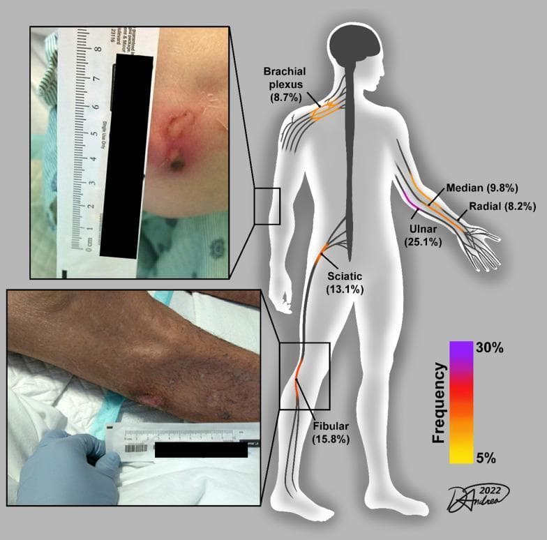 This medical infographic illustrates common peripheral nerve injury (PNI) sites in survivors of severe COVID-19. The central element is an anatomical diagram of a human figure highlighting several nerves with color-coded injury frequencies. The ulnar nerve (25.1%) is the most frequent site, followed by the common fibular (15.8%), sciatic (13.1%), median (9.8%), brachial plexus (8.7%), and radial (8.2%) nerves. A color-gradient scale (5% yellow to 30% purple) correlates with these frequencies. Two inset clinical photographs demonstrate stage-related skin pressure sores (decubitus ulcers) at critical compression points. The top inset shows an elbow ulcer with central necrosis and surrounding erythema, while the bottom inset depicts a pressure sore over the fibular head on a limb with darker skin pigmentation. Both clinical images include a surgical ruler for scale. The visual summarizes how mechanical loading during prolonged ICU hospitalization and prone positioning can lead to both skin breakdown and underlying axonal nerve injury, emphasizing the clinical relevance of monitoring bony prominences.