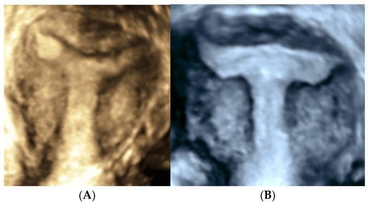 This diagnostic comparison chart features two side-by-side transvaginal three-dimensional (3D) ultrasound images of the coronal plane of the uterus, illustrating different Müllerian duct anomalies. Image (A) displays a Y-shaped uterine cavity, characterized by a smooth, wide bifurcation at the superior fundal region where the arms of the cavity extend diagonally. Image (B) demonstrates a T-shaped uterus (Class U1a according to ESHRE/ESGE classification), showing a narrow, tubular uterine body with a characteristic horizontal fundal configuration and lateral protrusions. The echogenic endometrial lining in image (B) is notably distinct against the darker myometrium, highlighting the constriction of the mid-segment. These images serve as educational references for gynecological radiology, focusing on the diagnosis of dysmorphic uteri and uterine malformations that may impact reproductive outcomes. The 3D reconstruction is essential for assessing the external fundal contour and internal cavity shape to differentiate between T-shaped, Y-shaped, and septate uterine variations.