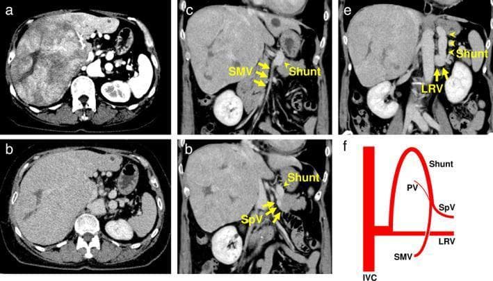 This composite figure includes contrast-enhanced computed tomography (CECT) scans and a corresponding anatomical diagram illustrating Congenital Absence of the Portal Vein (CAPV) Type II associated with hepatocellular carcinoma (HCC). (a) Axial arterial phase image shows a large, inhomogeneous hyperenhancing mass occupying the right lobe of the liver with a central hypoattenuating area suggestive of necrosis. (b) Axial portal venous phase image demonstrates the mass becoming isoattenuating relative to the liver parenchyma. (c-e) Coronal reconstruction images highlight a portosystemic shunt. Yellow arrows indicate the superior mesenteric vein (SMV) and splenic vein (SpV) joining to form a large shunt that drains directly into the left renal vein (LRV). (f) A schematic diagram summarizes the venous anatomy, showing the SMV and SpV bypassing the liver via a shunt to the LRV/IVC, with a hypoplastic portal vein (PV) branching toward the liver, characteristic of CAPV Type II. This case highlights the radiological features of hepatoma in the context of rare congenital vascular anomalies.