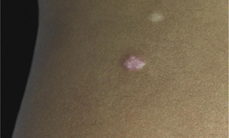 This clinical photograph displays a solitary, well-circumscribed papule on the left flank of a pediatric patient. The primary lesion is approximately 5 mm x 3 mm, exhibiting a rose or pink-erythematous coloration and a smooth, slightly dome-shaped surface. Superior and lateral to the main lesion, a smaller, faint whitish hypopigmented macule is also visible. The surrounding skin appears normal in texture and tone. This image serves as a dermatological example of a solitary adnexal tumor, such as syringocystadenoma papilliferum, characterized by its pink hue and gradual growth. The presentation is relevant for clinical training in identifying benign skin neoplasms and differentiating them from other pediatric papular lesions.