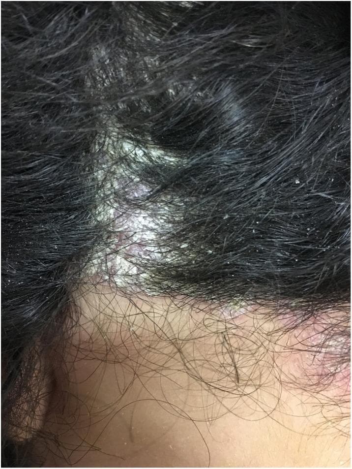 This clinical photograph shows a close-up view of the human scalp and posterior hairline, demonstrating well-demarcated erythematous plaques characteristic of scalp psoriasis. The lesions are covered with thick, silvery-white micaceous scales that adhere to both the underlying inflamed skin and the proximal hair shafts. The distribution is patchy, with prominent plaques extending beyond the frontal and temporal hair-bearing areas onto the adjacent non-terminal hair skin. The surrounding dark hair remains intact but contains scattered fine, flaky white debris (secondary scaling). The visible borders of the primary plaque are distinct and irregular. This image is an educational example of inflammatory dermatoses of the scalp, specifically illustrating the classic morphology and scaling pattern of psoriasis and pseudotinea amiantacea.