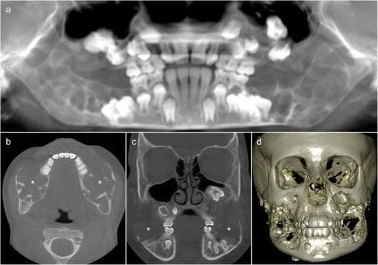 This composite of diagnostic images features Cone Beam CT (CBCT) scans and a 3D reconstruction of the skull from an 8-year-old pediatric patient, demonstrating classic radiographic features of cherubism. Panel (a) shows a thick-slab translucent CBCT reconstruction highlighting extensive, well-defined, bilateral multilocular radiolucencies causing symmetric expansion of the mandible and maxilla. Significant dental abnormalities are present, including unerupted first molars and displaced permanent teeth floating within the lesions. Axial (b) and coronal (c) cross-sections reveal pseudocystic osteolytic lesions containing fine, irregular bony septa (asterisks), with notable absence of periosteal reaction. These views further demonstrate the invasion of the inferior alveolar nerve canal and profound cortical thinning. Panel (d) provides a 3D volume-rendered reconstruction, visualizing the hypertrophic nature of the mandibular and maxillary lesions, which contribute to the characteristic 'cherubic' facial deformity and massive bony distortion. The content serves as an educational reference for diagnosing genetic fibro-osseous disorders of the jaw in pediatric oral and maxillofacial radiology.