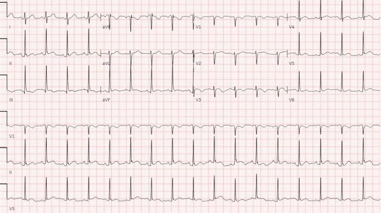 A standard 12-lead electrocardiogram (ECG) demonstrating sinus tachycardia. The tracing shows a regular rhythm with a heart rate exceeding 100 beats per minute, calculated at approximately 125 bpm based on R-R intervals of roughly 12 small boxes. Each narrow QRS complex is preceded by a normal, upright P wave in lead II, indicating a sinoatrial origin of the rhythm. The morphology of the QRS complexes, P waves, and T waves appears consistent across the limb leads (I, II, III, aVR, aVL, aVF) and precordial leads (V1-V6). No significant ST-segment elevation or depression is observed, and the axis appears normal. This diagnostic image illustrates a common physiological or pathological response to stress, pain, or underlying clinical conditions such as pulmonary embolism or cardiac masses, as mentioned in the clinical context. It is a foundational educational example for medical students and clinicians to recognize sinus tachycardia and differentiate it from other supraventricular tachycardias.