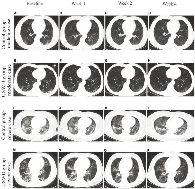 This diagnostic image is a longitudinal series of axial chest CT scans (lung window) demonstrating the progression of pulmonary pathology in patients with COVID-19. The layout is organized into a grid comparing a control group and an Ultra-Short Wave Diathermy (USWD) intervention group across moderate and severe disease classifications at four time points: baseline, Week 1, Week 2, and Week 4. In moderate cases (A-H), initial bilateral ground-glass opacities (GGOs), predominantly in the lower lobes and peripheral regions, show gradual resolution over the four-week period. In severe cases (I-P), the baseline scans (I, M) reveal extensive bilateral GGOs, consolidation, and early fibrotic changes. The time-series progression demonstrates varying rates of clearing. In the USWD severe group (M-P), there is a notable reduction in opacity and consolidation density by Week 4 compared to the control severe group (I-L), where residual stripe shadows and local pleural thickening persist. This visual comparison illustrates the natural history of COVID-19 pneumonia and the potential impact of therapeutic interventions on the rate of pulmonary tissue recovery.