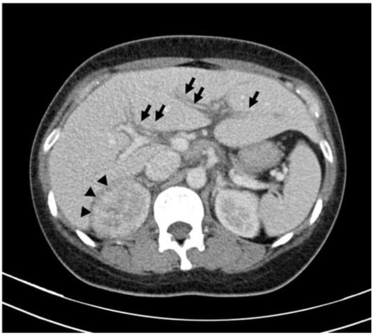 This axial contrast-enhanced CT scan of the abdomen demonstrates characteristic findings of acute pyelonephritis with associated extrarenal manifestations. The right kidney shows compromised corticomedullary differentiation and a distinct, hypoenhanced wedge-shaped lesion (marked by arrowheads), representing focal areas of inflammation or ischemia. In the hepatic region, there is significant reduced attenuation surrounding the intrahepatic portal veins (marked by arrows), which is diagnostic of periportal edema. The image illustrates the radiological presentation of severe urinary tract infection and the potential for systemic inflammatory responses leading to secondary hepatic findings. These markers are used clinically to assess the severity of pyelonephritis and the risk of urosepsis, as periportal edema often correlates with elevated inflammatory markers and prolonged clinical recovery.
