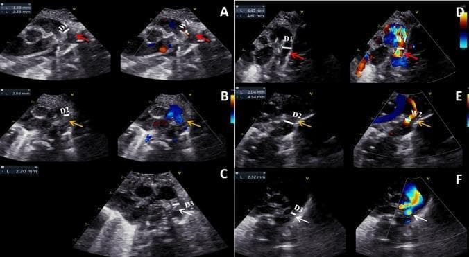This set of diagnostic images features longitudinal two-dimensional (2D) and color Doppler echocardiography of the ductus arteriosus (DA) in neonates. Panels A-C illustrate the 'PDA-closure group,' demonstrating the progressive stages of spontaneous closure. (A) shows a thin, hypoechoic, uneven intima with a patent lumen (D1) and wide transcatheter flow (W1) within 24 hours of birth. (B) displays intimal thickening and lumen occlusion by 48-72 hours. (C) shows the final formation of the hyperechoic ligamentum arteriosum with total cessation of flow at 26 days. Panels D-F depict the 'PDA-open group,' where the intima remains thinner and the lumen (D1-D3) stays more patent over time despite some contraction. Color Doppler confirms persistent shunting (blue and red flow signals) across the DA in the open group, while showing diminishing flow in the closure group. The series highlights the pathophysiology of neonatal DA remodeling, specifically the role of intimal cushions and contraction in transition from a patent ductus arteriosus to an anatomical ligament.