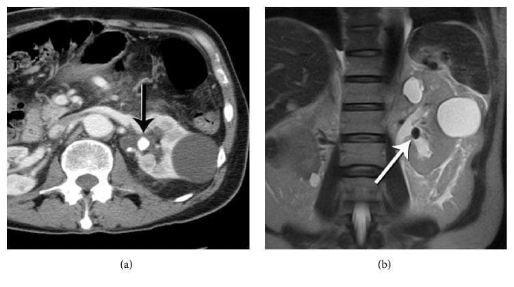 This dual-modality clinical diagnostic image compares the appearance of nephrolithiasis on Computed Tomography (CT) and Magnetic Resonance Imaging (MRI). Image (a) is an enhanced axial CT scan of the abdomen showing a high-density (hyperattenuating), well-defined calcified stone (arrow) located within the left renal pelvis. The kidney shows contrast enhancement of the parenchyma and a simple renal cyst on the lateral aspect. Image (b) is a coronal T2-weighted HASTE MRI of the same patient. In this modality, the stone (arrow) manifests as a distinct focal signal void (hypointense/dark) against the high signal intensity (hyperintense/bright) of the surrounding urine in the dilated collecting system. The vertebral column and paraspinal muscles are visible for anatomical reference. This comparison illustrates the different physical principles of stone detection: CT relies on radiodensity (Hounsfield units), whereas T2-weighted MRI identifies stones by the absence of signal relative to surrounding fluid, which is useful for diagnosing urolithiasis in populations where radiation sparing is preferred, such as pediatric or pregnant patients.