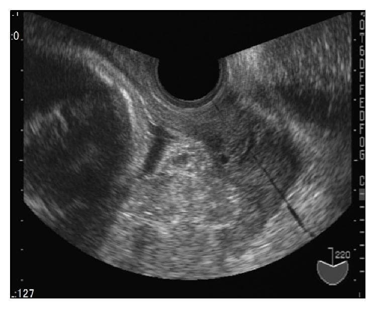 This diagnostic ultrasound image in the transverse plane demonstrates a placenta previa at approximately 33 weeks of gestation. The primary clinical focus is on the heterogeneous echotexture of the placental tissue following intrauterine fetal death (IUFD). The placenta occupies a significant portion of the lower uterine segment and is characterized by a granular, irregular appearance. Notable features include multiple scattered, irregular hyperechoic regions (bright white areas) embedded within the placental parenchyma. These high-echo regions are interspersed with areas of low-level echoes, indicating varied echogenicity across the tissue. This visual pattern is associated with reduced placental blood supply and changes occurring post-IUFD. The imaging modality is transvaginal or transabdominal ultrasonography, and the target audience includes obstetrics and gynecology professionals or medical students studying placental pathology and fetal growth restriction (FGR).