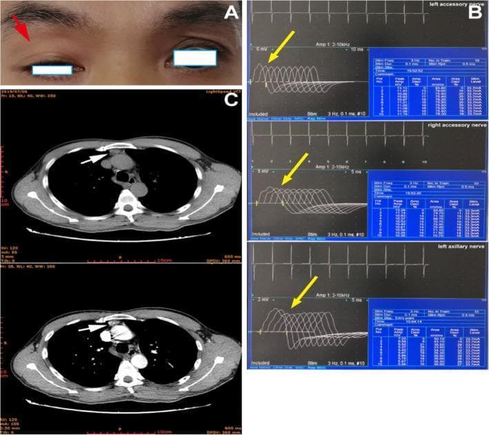 A composite medical image illustrating diagnostic manifestations of myasthenia gravis across three modalities. Panel A is a clinical photograph of the periorbital region showing asymmetrical ophthalmoparesis; a red arrow indicates significant ptosis of the right upper eyelid, which obscures the upper half of the pupil compared to the normal left eyelid position. Panel B displays results from a repetitive nerve stimulation (RNS) test of the bilateral accessory and left axillary nerves; yellow arrows highlight a decremental response in compound muscle action potential (CMAP) amplitudes, characteristic of neuromuscular junction dysfunction. Panel C contains two axial computed tomography (CT) images of the chest; white arrows point to an enlarged soft tissue mass in the anterior mediastinum, consistent with thymic hyperplasia. Together, these panels demonstrate the classic clinical triad of ocular symptoms (ptosis), electrophysiological evidence of fatigue, and associated anatomical abnormalities (thymus) often found in autoimmune myasthenia gravis.