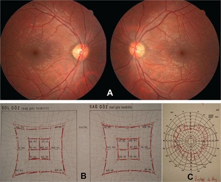 This composite ophthalmological diagnostic image demonstrates postoperative assessment findings in a patient following treatment for bilateral superior oblique palsy. Section A contains bilateral fundus photographs showing healthy retinal backgrounds, clear optic discs with distinct margins, and normal vascular distribution. Critically, the fovea-to-disc relationship demonstrates an absence of ocular torsion, indicating successful surgical correction. Section B displays a Hess screen test, featuring two grids for the left (Sol Göz) and right (Sağ Göz) eyes. The red-lined inner and outer squares are symmetrical and of normal size, signifying restored extraocular muscle function without significant underaction or overaction. Section C shows a binocular visual field chart (Goldmann perimetry or similar) illustrating an expanded field of single binocular vision, denoted by the central plotted area. These combined clinical materials illustrate the resolution of diplopia and cyclotorsion through specialized strabismus surgery, specifically Harada-Ito (HI) procedures, aimed at restoring ocular alignment and binocularity.