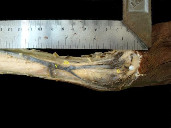 This clinical anatomical specimen photograph displays a superficial dissection of the distal forearm and wrist, focusing on the neurovascular relationships along the radial aspect. Key anatomical landmarks are identified with yellow labels: the radial styloid process is marked as 'O' (indicated by a white pin), the superficial branch of the radial nerve is labeled 'SB', and the cephalic vein is labeled 'V'. The image demonstrates the close proximity and crossover point of the cephalic vein and the sensory branches of the radial nerve as they course distally toward the dorsal hand. A metallic caliper and ruler are positioned alongside the specimen to provide a metric scale for morphometric measurements between the styloid process and nerve-vein intersections. This educational visual is designed to assist in understanding surgical anatomy for procedures such as cephalic vein cannulation or radial artery harvesting, where avoiding injury to the superficial branch of the radial nerve is critical.