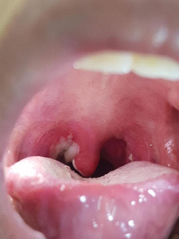 This clinical photograph displays a close-up intraoral view of the oropharynx in a pediatric patient. The primary finding is a classic, thick, grayish-white pseudomembrane that is firmly adherent to the pharyngeal wall and tonsillar region. The surrounding mucosal tissues, including the uvula and soft palate, exhibit significant erythema and inflammation. This visual presentation is characteristic of pharyngeal diphtheria caused by toxigenic Corynebacterium diphtheriae. The pseudomembrane is a hallmark diagnostic sign, formed by a dense collection of necrotic epithelium, fibrin, leukocytes, and bacteria. In the foreground, the tongue and lower teeth are visible, providing anatomical orientation. This image serves as a critical educational example for infectious disease diagnosis, particularly in the context of vaccine-preventable respiratory infections and their clinical manifestations like 'bull neck' lymphadenopathy and systemic toxemia.