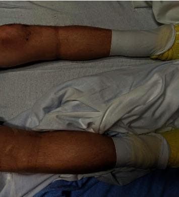 Clinical photograph of a patient's lower extremities in a supine position, demonstrating significant bilateral pedal edema. The swelling is symmetrical, extending from the feet proximally to the level of the knees. The skin over the shins and calves appears taut, shiny, and distended, characteristic of high-grade pitting edema (clinically noted as 4+). Both feet are covered with white medical compression wraps or dressings, with yellow non-slip hospital socks visible. This image serves as a clinical example of generalized peripheral edema, which in this educational context is associated with insulin-induced edema. Key landmarks include the visible distension of the pretibial area and the ankle region, contrasting with the proximal thigh area above the knee where the swelling appears to terminate. This visual is relevant for training in physical examination, fluid volume assessment, and recognizing secondary side effects of endocrine therapies.