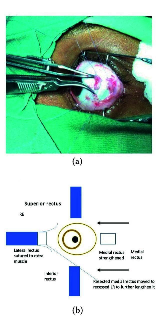 This composite educational resource consists of a clinical photograph and a corresponding anatomical diagram illustrating a complex strabismus surgical procedure. The photograph (a) depicts an intraoperative view of a human eye draped for surgery. The sclera is exposed, showing localized vascular congestion and surgical trauma. Fine blue monofilament sutures are visible, and ophthalmic forceps are seen manipulating a resected extraocular muscle tendon. The diagram (b) provides a schematic representation of the 'transplantation of resected medial rectus to the lateral rectus.' It labels the four rectus muscles—Superior, Inferior, Lateral (LR), and Medial (MR)—and uses arrows and annotations to explain the surgical logic: the resected MR is being moved to the recessed LR to further lengthen it, a technique typically used for ocular alignment in conditions like severe nerve palsy. This visual illustrates key concepts in ophthalmic reconstructive surgery and extraocular muscle transposition techniques for advanced strabismus management.