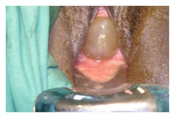 This clinical photograph illustrates a case of cervical insufficiency during pregnancy, specifically showing extensive bulging of the fetal membranes (hour-glassing) through the cervical os into the vaginal vault. The fetal membranes appear as a smooth, translucent, globular, and fluid-filled sac with a pale yellowish-tan hue. The surrounding cervical and vaginal tissues exhibit significant erythema and vascularity, indicative of inflammation. A metal vaginal speculum is positioned at the base of the image to provide exposure of the pelvic region. This visual is characteristic of second-trimester cervical dilation and prolapse of the amniotic sac, a critical clinical finding often necessitating emergent cerclage procedures such as the Shirodkar or McDonald technique. The image serves as an educational resource for identifying pre-viable or early viable pregnancy complications related to cervical incompetence.