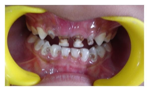 An intraoral clinical photograph of a pediatric patient (4 years old) demonstrating severe, multi-surface dental caries characteristic of Early Childhood Caries (ECC). The maxillary anterior deciduous teeth, including the central and lateral incisors (teeth 51, 52, 61, 62), show advanced destruction of the crown structure with significant cavitation and deep dark brown to black necrotic dentin. The mandibular arch also exhibits widespread caries, primarily affecting the labial and occlusal surfaces of the deciduous incisors, canines, and molars, with visible yellowish demineralization and focal brown lesions at the cervical margins. The maxillary gingiva displays signs of moderate inflammation and erythema. This image serves as a clinical example of nursing bottle syndrome or aggressive childhood caries requiring comprehensive restorative and endodontic intervention.