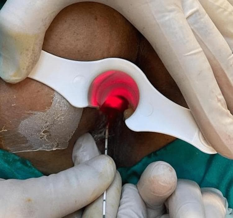 This clinical photograph provides an intraoperative view of a laser ablation procedure for a fistula-in-ano. The surgical field focuses on the perianal region, where a white, plastic, single-use anal retractor is being held by gloved hands to facilitate exposure. A thin, graduated laser probe from the neoV1470 Laser System is inserted into the fistula tract. A distinctive bright red laser light is visible within the anal canal, indicating the active ablation of the tract lumen. The image demonstrates the precise placement of the fiber-optic probe and the use of specialized retraction to maintain a clear visual field during minimally invasive colorectal surgery. The educational focus is on the technique of Laser-assisted Closure of Fistula (FiLaC), highlighting the equipment used, including the marked probe for depth measurement and the laser's thermal effect on tissue.