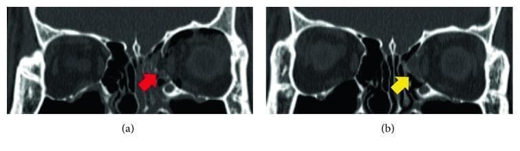 Coronal non-contrast CT scans of the orbits demonstrating a comparison between an acute medial orbital wall fracture and its surgical reconstruction. In image (a), a red arrow indicates a significant bony defect and discontinuity of the left medial orbital wall (lamina papyracea), characteristic of a blowout fracture with potential herniation of orbital contents into the ethmoid sinus. Image (b) shows the same anatomical region postoperatively, where a yellow arrow identifies a combined implant consisting of a resorbable meshed plate and allogenic bone substitute. The implant is seen bridging the previous defect, restoring the structural integrity and contour of the medial orbital wall. The reconstructed area exhibits a hybrid density lower than cortical bone but higher than surrounding soft tissue, indicating successful reduction and placement of the graft material. This comparison illustrates common diagnostic findings in maxillofacial trauma and the appearance of bioresorbable implants in orbital floor and wall repair.