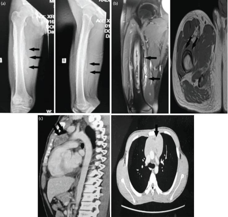 This composite of diagnostic images illustrates multi-modal findings of synchronous pathologies in a pediatric patient. Panel (a) contains anterior-posterior and lateral radiographs of the right femur, demonstrating a prominent lamellated (onion-skin) periosteal reaction along the femoral diaphysis, accompanied by significant soft tissue swellingβfeatures classic for aggressive bone tumors like Ewing sarcoma or parosteal osteosarcoma. Panel (b) shows MRI sequences (coronal T2-weighted fat-saturated and axial T1-weighted) revealing a large intramedullary mass with extensive extraosseous soft tissue extension and cortical involvement. Panel (c) presents contrast-enhanced CT images of the thorax in sagittal and axial views. These images show a large, lobulated anterior mediastinal mass (indicated by arrows) with internal hypodense areas, suggestive of necrosis or cystic components. The collection serves as an educational example of oncological staging, highlighting how secondary findings in the thorax may represent distinct primary entities (such as a germ cell tumor) rather than metastatic disease.