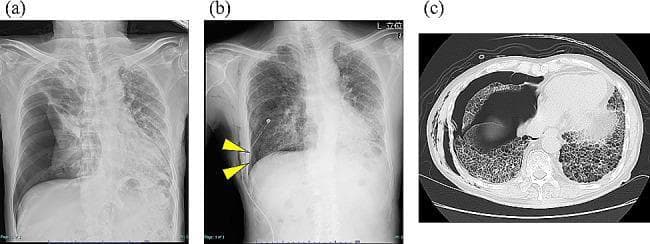 Educational clinical image set documenting a secondary pneumothorax in a patient with chronic hypersensitivity pneumonitis. Panel (a) is a posterior-anterior (PA) chest X-ray showing a large right-sided tension pneumothorax with significant mediastinal shift to the left and complete collapse of the right lung. Panel (b) is a follow-up chest X-ray post-thoracic drainage showing a visible chest tube and a persistent, mild residual pneumothorax cavity (indicated by yellow arrowheads) along the right lateral chest wall. Both radiographs reveal underlying diffuse reticular opacities consistent with interstitial lung disease. Panel (c) is an axial non-contrast chest CT scan (lung window) demonstrating extensive bilateral subpleural honeycombing and ground-glass opacities characteristic of advanced pulmonary fibrosis. The CT also captures the collapse of the right middle and lower lobes and an associated pleural air space. The series demonstrates the complication of intractable air leak in the context of advanced fibrotic lung disease.