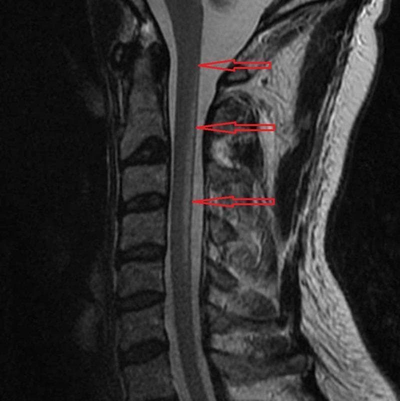 A sagittal T2-weighted magnetic resonance imaging (MRI) scan of the cervical spine. The diagnostic image demonstrates abnormal hyperintense (high) signal intensity within the posterior aspect of the spinal cord, specifically localized to the dorsal columns. This longitudinal signal abnormality is marked by three red horizontal arrows and extends from the C2 vertebral level down to the C5 level. The spinal cord maintains its normal caliber without significant edema or expansion. These radiographic findings are characteristic of Subacute Combined Degeneration (SCD) of the cord, typically associated with Vitamin B12 deficiency or nitrous oxide toxicity. The image serves as an educational example of metabolic myelopathy, illustrating the selective involvement of the posterior columns in the cervical region for medical students and neurology residents.