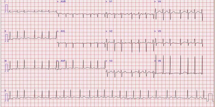 A standard 12-lead electrocardiogram (ECG) demonstrating atrial fibrillation with a rapid ventricular response. The tracing shows a classic 'irregularly irregular' rhythm characterized by highly variable R-R intervals across all leads (I, II, III, aVR, aVL, aVF, and V1-V6). There is a distinct absence of organized P waves, replaced by fine, low-amplitude fibrillatory waves visible in the baseline, particularly evident in lead V1 and the rhythm strip at the bottom (lead II). The QRS complexes are narrow, suggesting supraventricular origin of the rhythm. T-wave morphology appears generally normal without acute ST-segment changes. The clinical significance of this tracing is the confirmation of tachyarrhythmic atrial fibrillation, often associated with systemic conditions such as hyperthyroidism or Graves' disease in a clinical context. The image serves as a key diagnostic example for medical students and clinicians to identify irregular ventricular rates and the loss of atrial mechanical activity on an ECG.