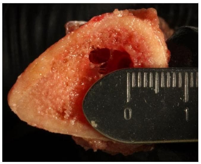 This clinical specimen photograph displays a cross-sectional view of a human tibial section, highlighting the distinctive architecture of long bones. The image demonstrates a clear differentiation between the peripheral cortical bone and the central cancellous (trabecular) bone. The outer cortical layer is dense, compact, and exhibits a smooth, yellowish-white appearance. In contrast, the internal cancellous region shows a porous, spongy texture with a characteristic reddish-pink hue, indicating the presence of marrow space and a complex trabecular network. A surgical osteotomy or prepared drill hole is visible within the medullary region. A metallic surgical ruler is positioned against the sectioned surface for scale, confirming a total thickness of approximately 6 mm, consisting of roughly 3 mm of cortical bone and 3 mm of cancellous bone. This visual is intended for orthopedic education and biomechanical research, specifically regarding the preparation of implant osteotomies and the evaluation of bone density and structural integrity in surgical sites.