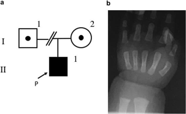 This composite educational graphic includes a family pedigree chart and a pediatric diagnostic radiogram. Panel A displays a pedigree indicating an autosomal recessive inheritance pattern; the proband (P) is an affected male (shaded square) born to carrier parents (dotted circle and square). Panel B is an anteroposterior (AP) roentgenogram of a pediatric hand and wrist. The primary diagnostic finding is significant metaphyseal cupping and fraying of the distal ulna. The skeletal structures, including the radius, carpal bones, metacarpals, and phalanges, exhibit generally reduced radiographic bone density (osteopenia). The visible cupping of the distal ulnar metaphysis is a hallmark sign of metabolic bone disease, typically associated with conditions such as rickets. This visual serves to illustrate the clinical manifestations of inherited metabolic disorders—specifically those affecting calcium, magnesium, or vitamin D homeostasis—leading to skeletal mineralization defects in early childhood.