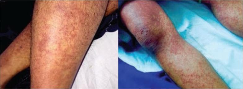 Two clinical photographs depict the lower limbs of a patient featuring an extensive cutaneous eruption. The rash is characterized by diffuse, reddish-purple macules and small papules that vary in morphology across different anatomical sites. On the shins and calves, the lesions appear as discrete, pinpoint petechiae and maculopapular elements distributed in a somewhat scattered fashion. In contrast, the region surrounding the knee shows higher lesion density with confluent erythematous patches and deep purpuric areas, suggesting palpable purpura or intense vascular inflammation. The underlying skin exhibits mild mottling and generalized erythema. This visual presentation is highly characteristic of systemic vasculitis (such as IgA vasculitis/Henoch-Schönlein purpura) or other hematologic conditions presenting with dependent purpura. These images serve as an educational resource for identifying vascular skin lesions, distinguishing between petechiae and confluent purpuric patches, and observing the characteristic dependent distribution of such dermatological manifestations.