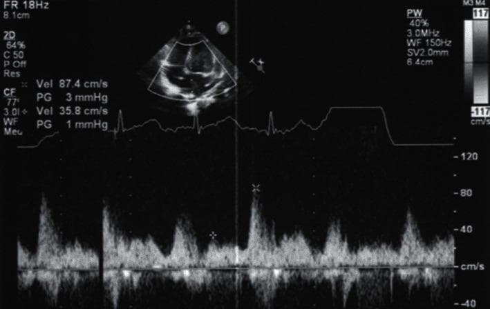 This diagnostic image is a transthoracic echocardiogram of a 4-month-old infant, featuring a 2D anatomical view and a pulse-wave (PW) spectral Doppler tracing. The 2D window at the top left shows a cardiac cross-section used for sample volume placement. Below this, a spectral Doppler waveform displays blood flow velocities over time, synchronized with a simultaneous ECG tracing. The Doppler signal demonstrates a pulsatile, phasic flow pattern across an anastomosis between a common chamber and the left atrium, following surgical repair for Total Anomalous Pulmonary Venous Connection (TAPVC). Measurement cursors identify a peak velocity (Vel) of 87.4 cm/s corresponding to a low pressure gradient (PG) of 3 mmHg, and a secondary velocity of 35.8 cm/s with a 1 mmHg gradient. The lack of continuous high-velocity flow or significant turbulence indicates the absence of anastomotic stenosis. This imaging is clinically significant for postoperative monitoring of pulmonary venous return and assessing for pulmonary vein stenosis in pediatric cardiology.