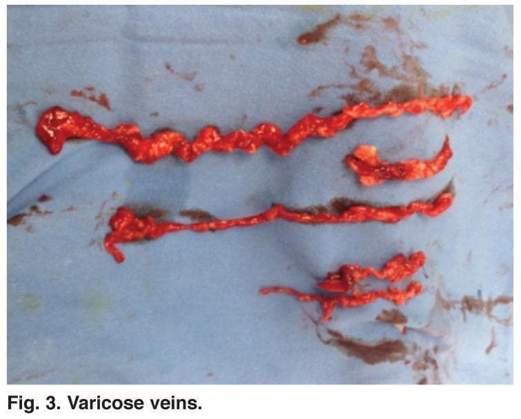 This clinical photograph displays gross surgical specimens of human varicose veins post-phlebectomy. The specimens consist of several segments of diseased venous tissue laid out on a blue surgical drape. The veins exhibit classic gross pathological features of chronic venous insufficiency, including extreme tortuosity, irregular dilation (varicosity), and a twisted, rope-like appearance. The texture is nodular and uneven, with visible focal distensions and constrictions along the length of the vessels. The specimens appear bright red and congested, likely due to intraluminal blood and the inflammatory nature of the diseased vessels. This image serves as a pathological reference for the morphological changes occurring in the great saphenous vein system or its branches during advanced venous disease, highlighting the structural degradation that necessitates surgical intervention such as ambulatory phlebectomy or radiofrequency ablation.
