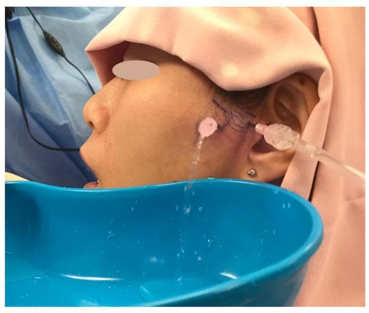 This intraoperative clinical photograph demonstrates a temporomandibular joint (TMJ) arthrocentesis procedure being performed on a patient in a semi-supine position. The surgical field is prepared with sterile pink and blue drapes, and the patient's eyes are protected. Visible markings on the preauricular skin delineate the anatomical landmarks for needle placement. Two cannulas or needles are inserted into the superior joint space of the TMJ: one serves as the inflow port for irrigation fluid (lysis and lavage), and the other serves as the outflow port. A clear stream of irrigation fluid is seen exiting the outflow cannula and collecting into a blue kidney basin held beneath the jaw. This procedure is typically used for the management of temporomandibular disorders (TMD), such as internal derangement or closed lock, to wash out inflammatory mediators and release fine adhesions within the joint.